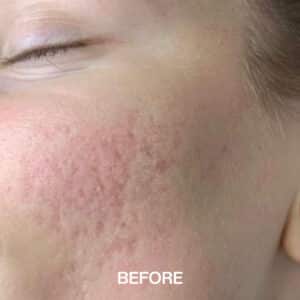 Laser Treatment for acne scars near me